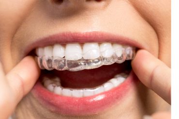 Retrouvez le sourire avec l’orthodontie invisible